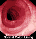 normal colonoscopy.png