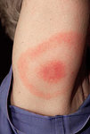 erythema migrans.jpg